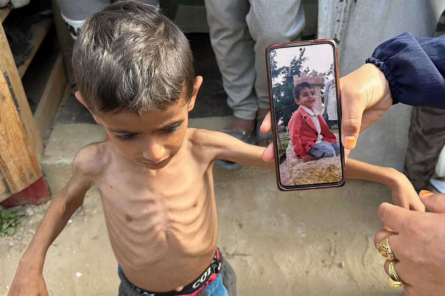 UNICEF : Kasus Malnutrisi Anak Melonjak 600 % dalam 5 Bulan  di Gaza